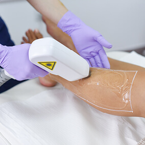 Laser hair removal treatment on leg