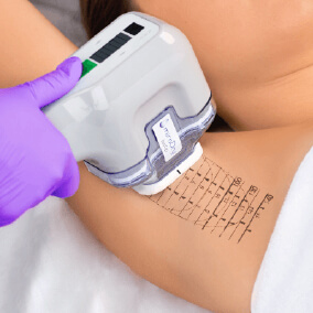 MiraDry treatment on underarm