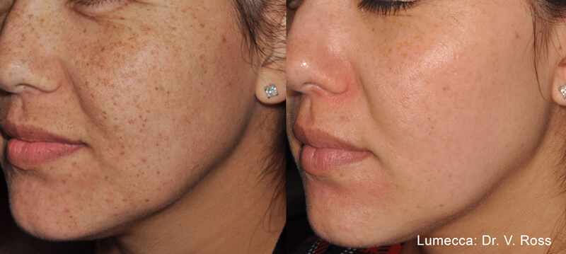 before-and-after-oxygeneo-evens-pigmentation-on-young-womans-face
