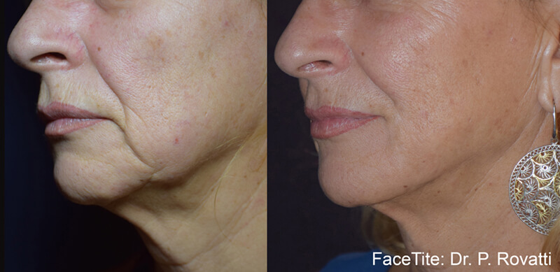 results-from-oxygeneo-on-middle-aged-woman