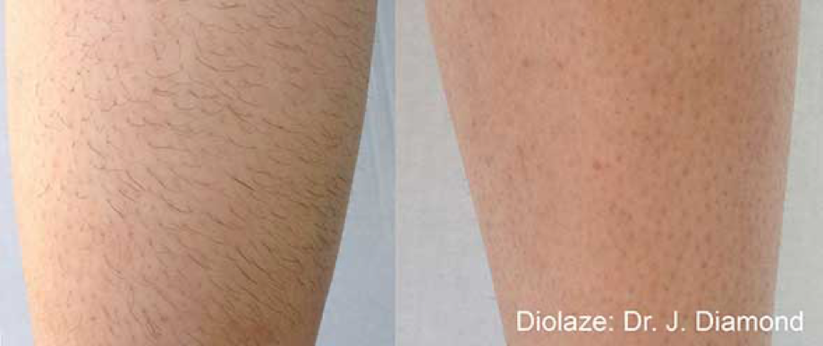 Laser Hair Removal Before and After Pictures of Actual Patients