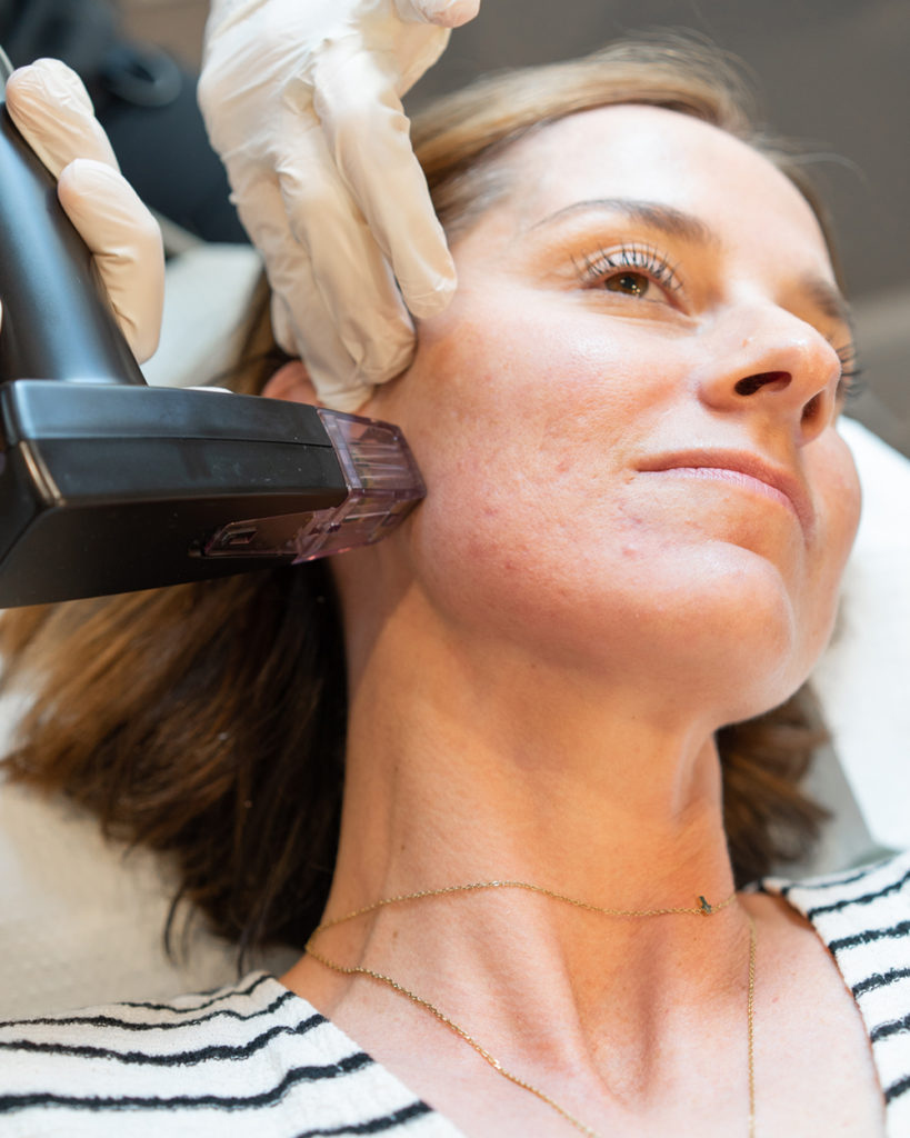 woman receiving skin resurfacing on her face