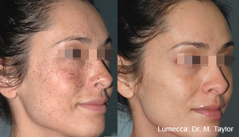 before and after photo rejuvenation of womans face