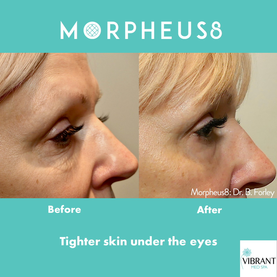 before and after of morpheus8 skin tightening
