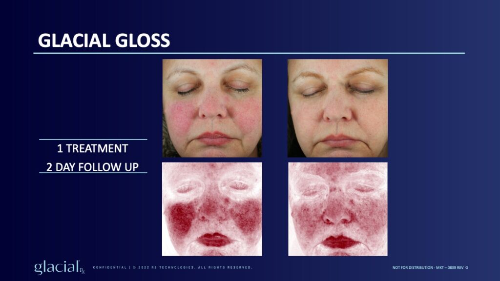 Glacial RX results Round Rock TX at Vibrant Med Spa