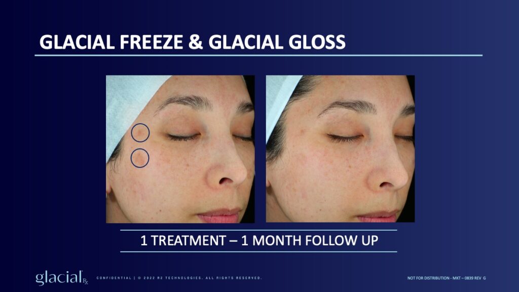 GlacialRX treatment results Round Rock TX Vibrant Med Spa