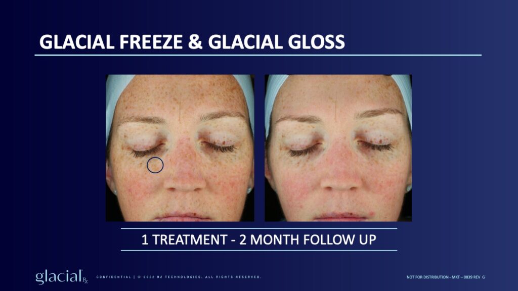 Glacial RX treatment Round Rock Vibrant Med Spa