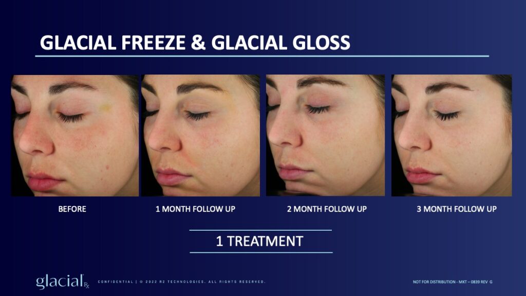 Glacial RX results Vibrant Med Spa Round Rock TX