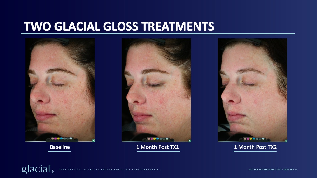 Glacial Rx at Vibrant Med Spa in Round Rock, Texas