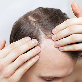 Man parting his hairline to show thinning prior to hair loss treatment