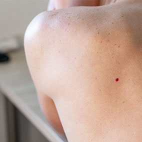 A freckled shoulder