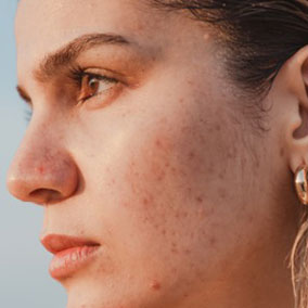 iPixel treatment on face