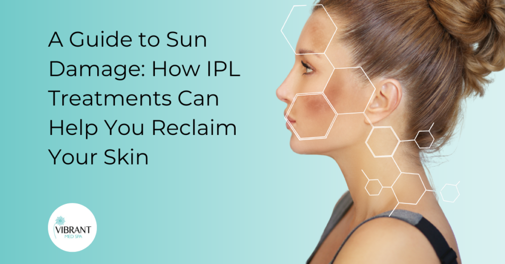 IPL for sun damage
