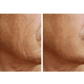 PDO threads before and after treatment
